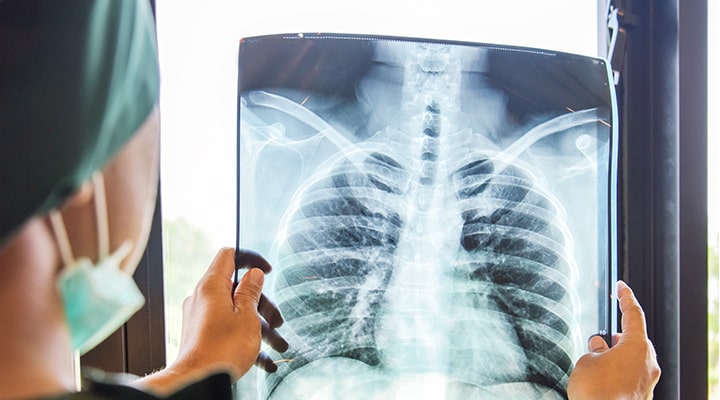 Gizli Akciğer Kanseri Vakaları Koronavirüs Nedeniyle Çekilen Tomografilerde Ortaya Çıkıyor